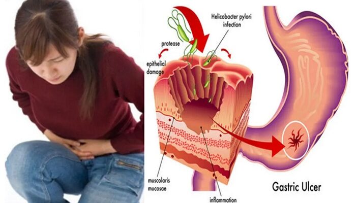 Ini Pertolongan Pertama Terhadap Penderita Penyakit Asam Lambung Saat Kumat